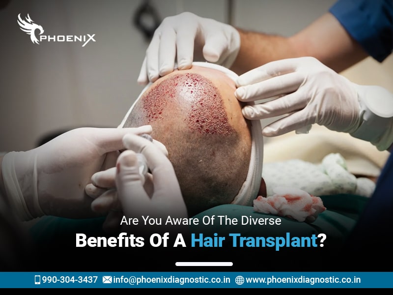 Are You Aware Of The Diverse Benefits Of A Hair Transplant?