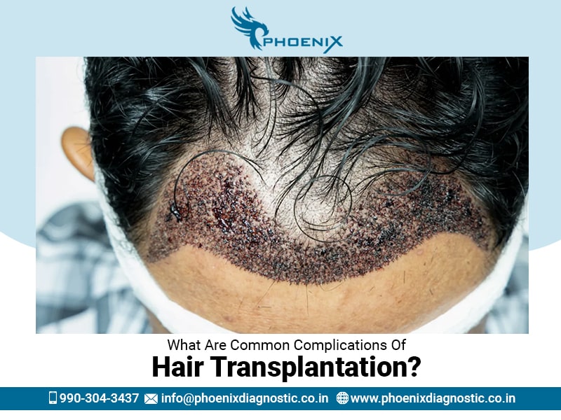 What Are Common Complications Of Hair Transplantation?