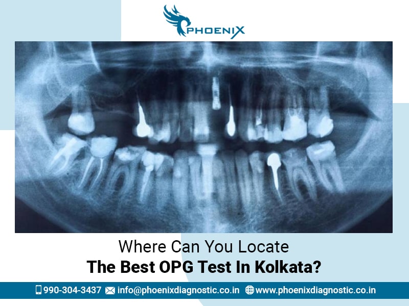 Where Can You Locate The Best OPG Test In Kolkata?