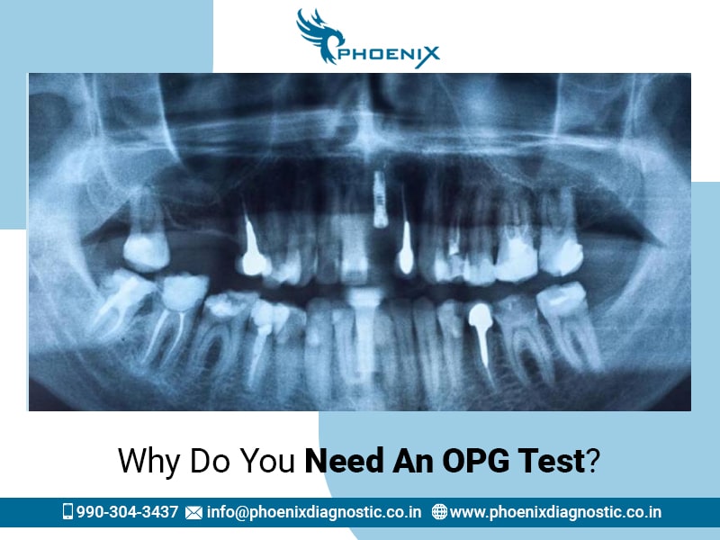 Why Do You Need An OPG Test?