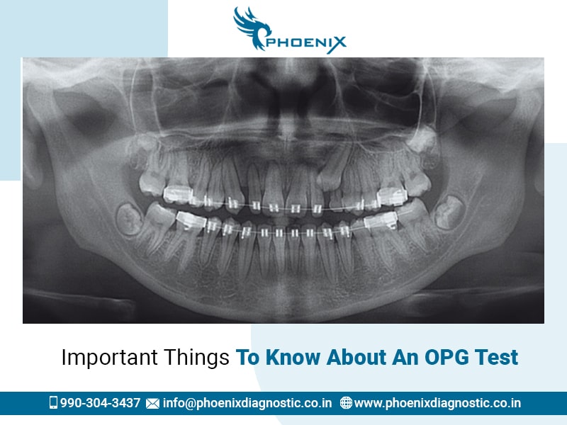 Important Things To Know About An OPG Test