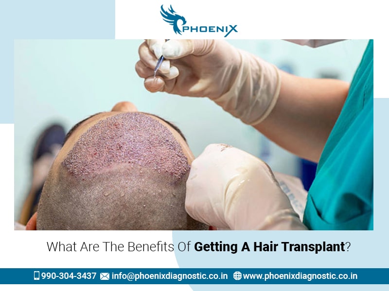 What Are The Benefits Of Getting A Hair Transplant?